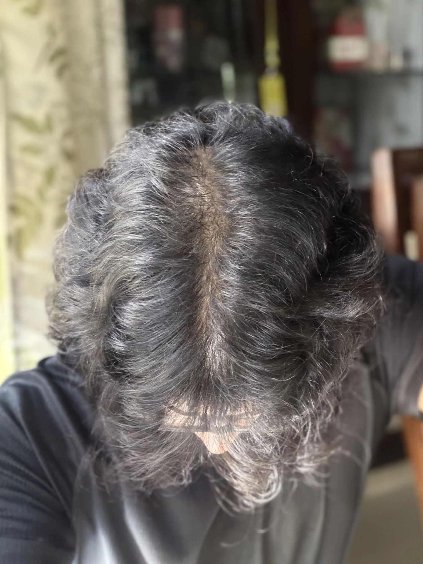 Reversed Androgenetic Alopecia
